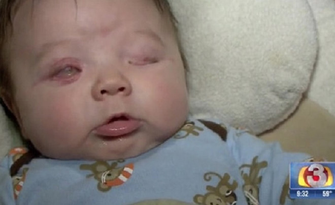 Tật không nhãn cầu và mắt nhỏ - Hình ảnh minh họa